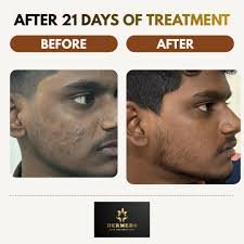 Skin Treatment Result 2