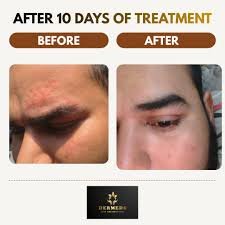 Skin Treatment Result 5
