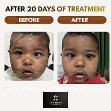 Skin Treatment Result 6