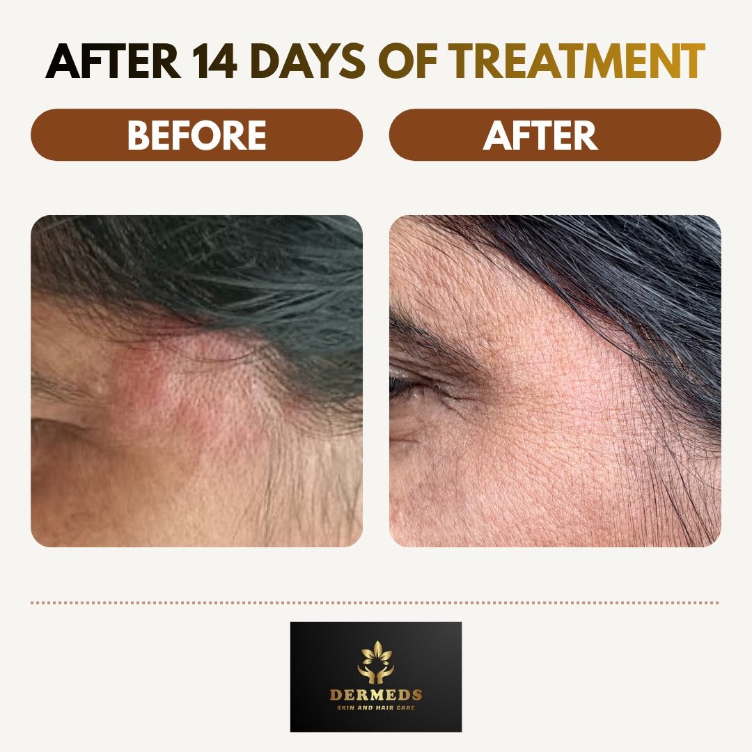 Skin Treatment Result 2