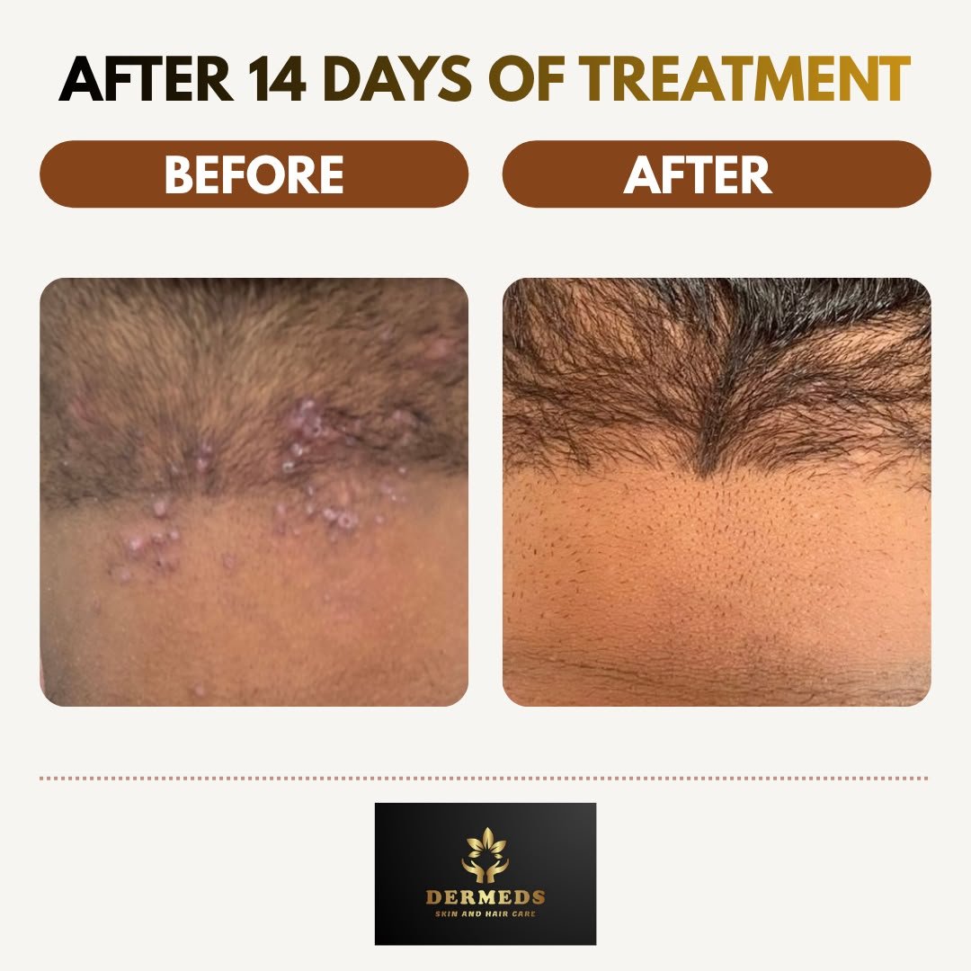 Skin Treatment Result 2